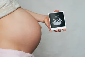 Baby Hair On 3D/4D Ultrasound