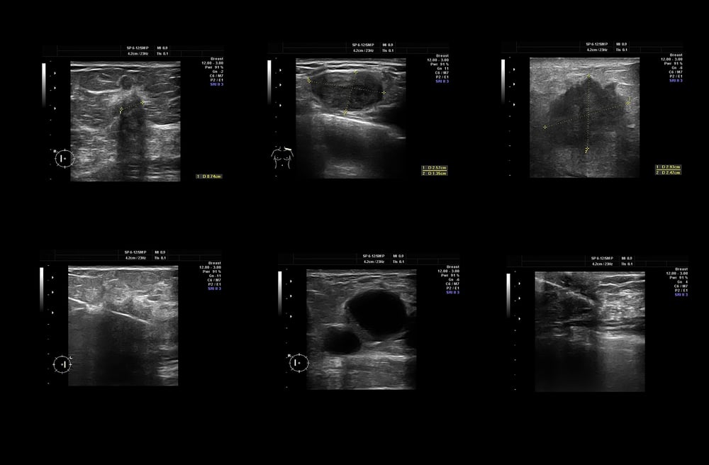 Can Sonograms Detect Cancer?