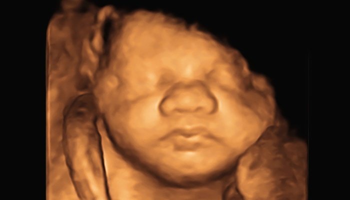 What Does Hair Look Like On A 4D Ultrasound?