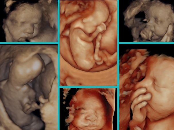 What Is The Difference Between A Normal Ultrasound And A 4D Ultrasound?