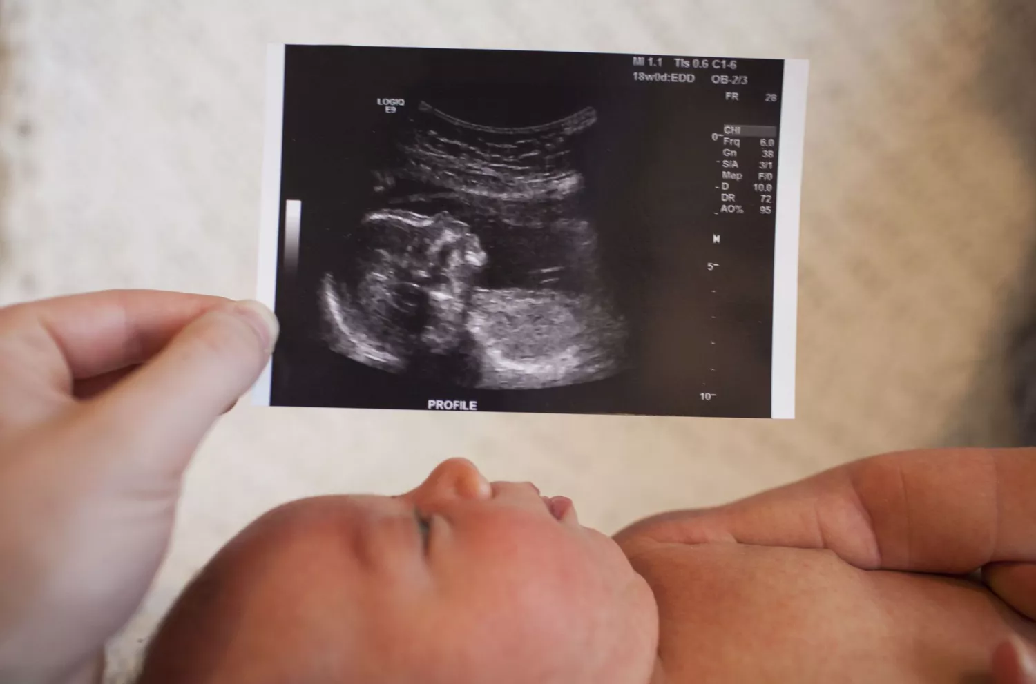 Why would a newborn get an ultrasound?