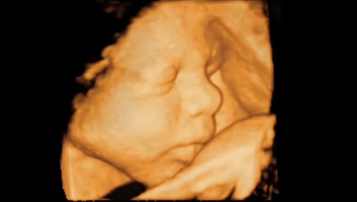 3D ultrasound
