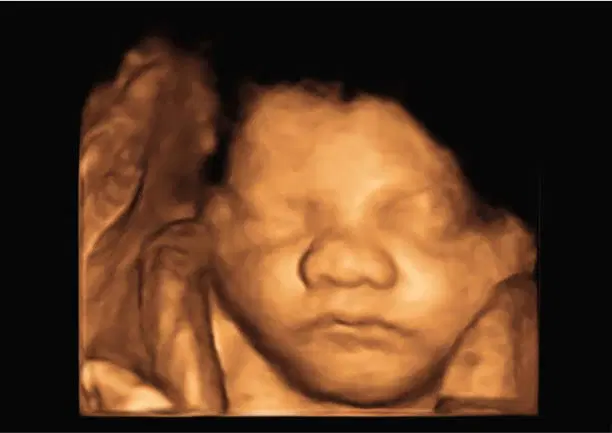 4D ultrasound