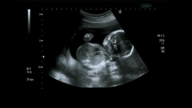 4D Ultrasound