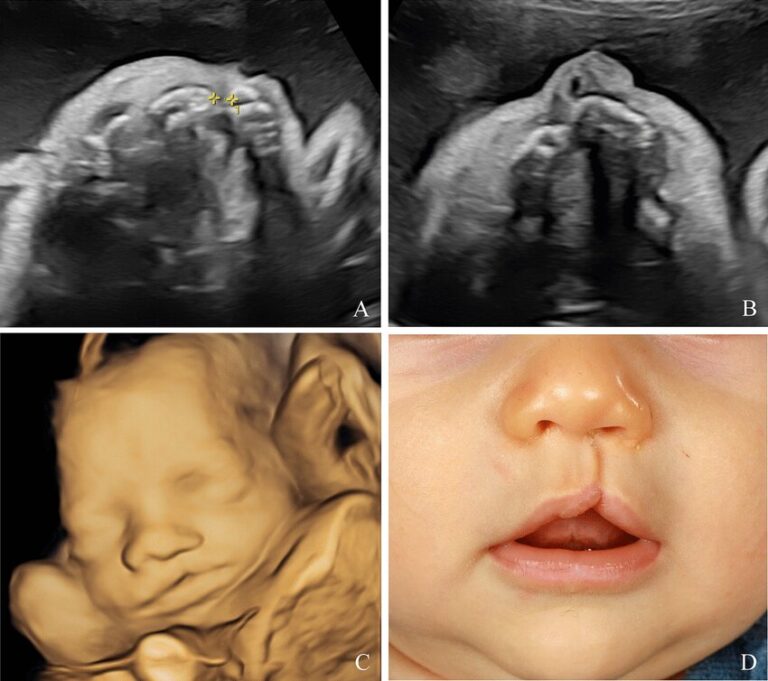 detection of cleft lip