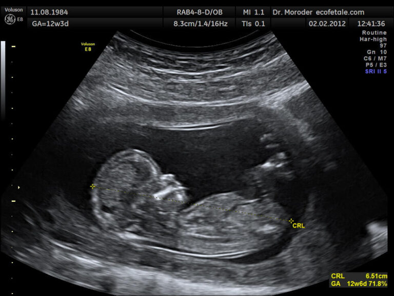 4D Ultrasound
