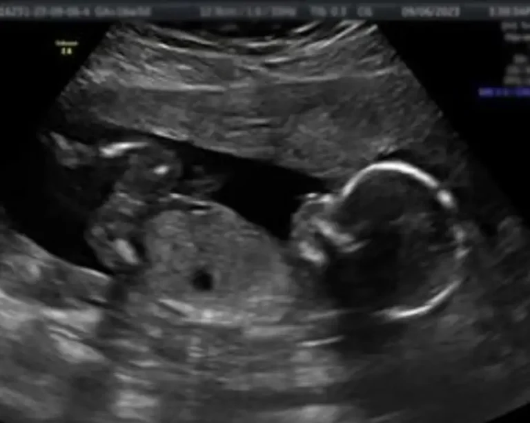 3D Ultrasound Experience