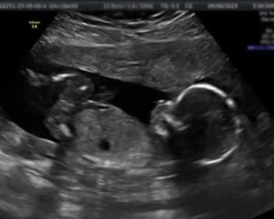 3D Ultrasound Experience