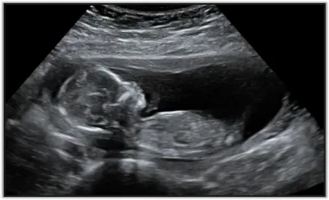 3D ultrasound