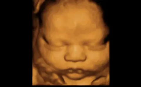 4D ultrasound